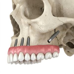 Perché l’osso per i denti fissi esiste sempre: il grande abbaglio delle diagnosi sbagliate